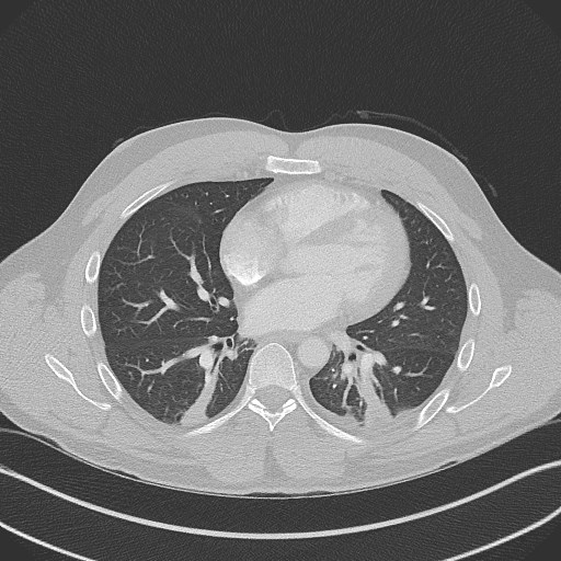 Bilateral atelectasis (Radiopaedia 48666-53675 Axial lung window 66).jpg