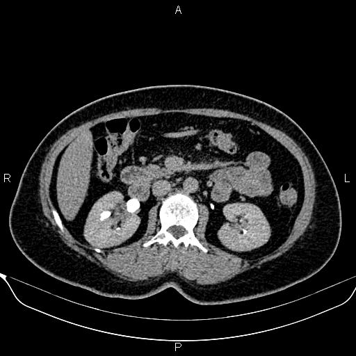 Bilateral benign adrenal adenomas (Radiopaedia 86912-103124 Axial C+ delayed 62).jpg
