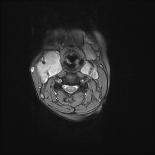 File:Bilateral carotid body tumors and right jugular paraganglioma (Radiopaedia 20024-20060 Axial 78).jpg