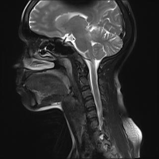 File:Bilateral carotid body tumors and right jugular paraganglioma (Radiopaedia 20024-20060 Sagittal 25).jpg
