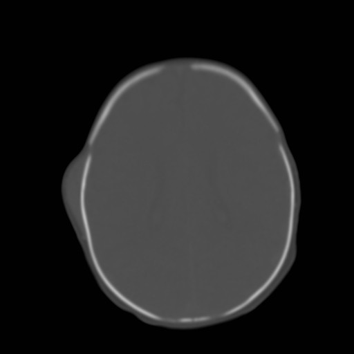 File:Bilateral cephalohematomas and subdural hematomas (Radiopaedia 26778-26929 Axial bone window 19).jpg