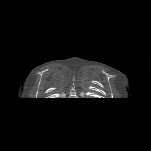 Bilateral chronic posterior shoulder dislocation (Radiopaedia 39213-41452 Coronal bone window 59).jpg