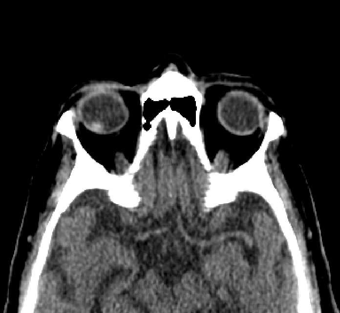 Bilateral ectopia lentis (Radiopaedia 89889-107013 Axial non-contrast 25).jpg