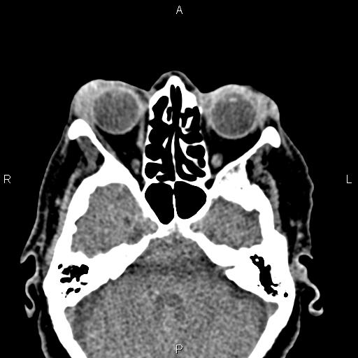 Bilateral enlargement of lacrimal glands - sarcoidosis (Radiopaedia 62627-70921 Axial non-contrast 39).jpg