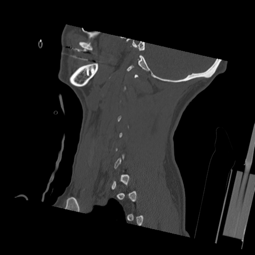 Bilateral locked facets (Radiopaedia 33850-35023 Sagittal bone window 13).png