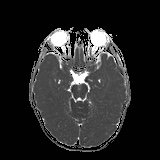 File:Bilateral mesial temporal polymicrogyria (Radiopaedia 76456-88181 Axial ADC 9).jpg