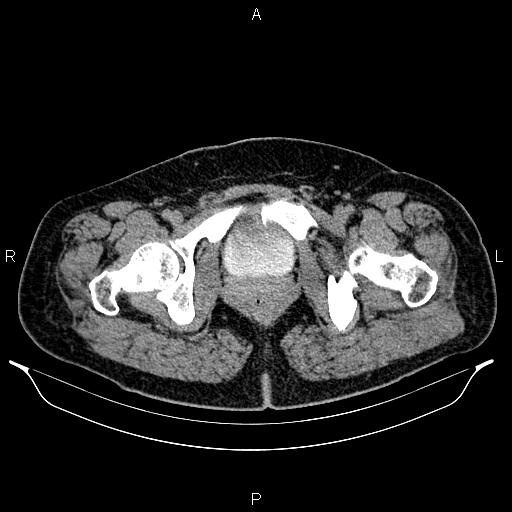 Bilateral ovarian dermoid cysts (Radiopaedia 85785-101603 Axial C+ delayed 87).jpg