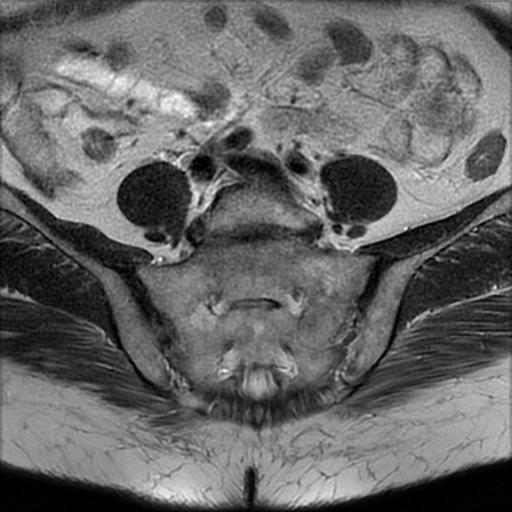 File:Bilateral ovarian dermoid cysts (Radiopaedia 90152-107338 Axial T2 2).jpg