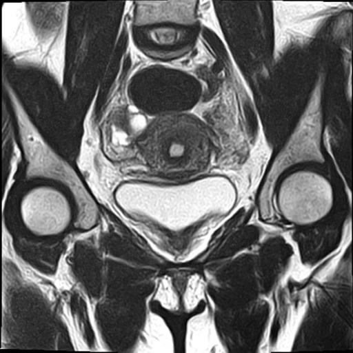 File:Bilateral ovarian endometriomas (Radiopaedia 87085-103347 Coronal T2 8).jpg