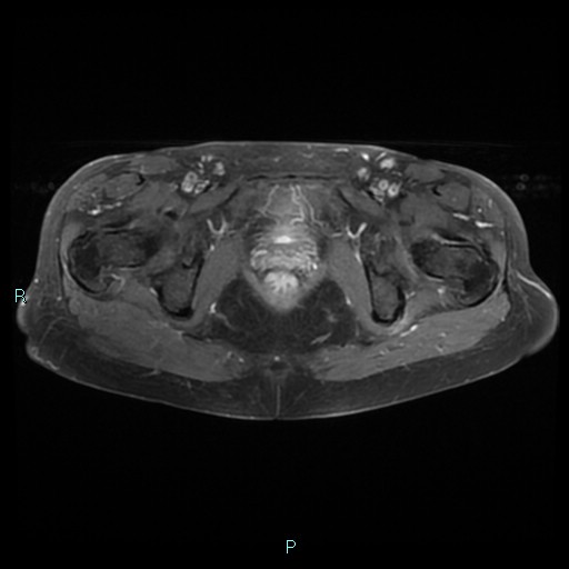 File:Bilateral ovarian fibroma (Radiopaedia 44568-48293 Axial T1 C+ fat sat 24).jpg