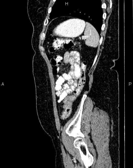 Bilateral ovarian serous cystadenocarcinoma (Radiopaedia 86062-101989 E 73).jpg