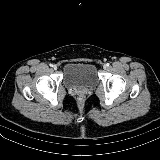 Bilateral ovarian teratoma (Radiopaedia 83131-97503 Axial With contrast 70).jpg
