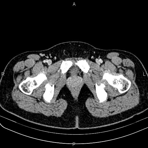 Bilateral ovarian teratoma (Radiopaedia 83131-97503 Axial With contrast 79).jpg