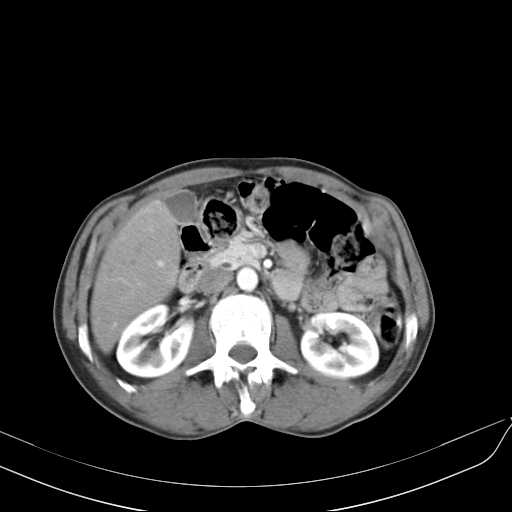 Bilateral parotid gland lymphoma (Radiopaedia 21038-20969 A 59).jpg