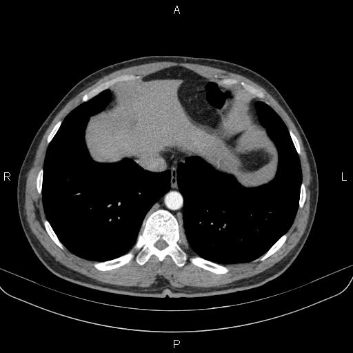 Bilateral pulmonary AVM (Radiopaedia 83134-97505 A 58).jpg