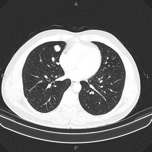 File:Bilateral pulmonary AVM (Radiopaedia 83134-97505 Axial lung window 46).jpg