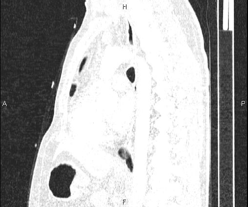 Bilateral pulmonary AVM (Radiopaedia 83134-97505 Sagittal lung window 64).jpg