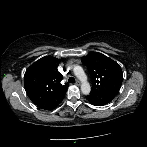 Bilateral pulmonary emboli (Radiopaedia 32700-33669 Axial C+ CTPA 35).jpg