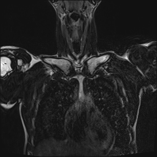 Bilateral spinoglenoid notch ganglion cysts (Radiopaedia 29577-30082 Coronal T2 31).jpg