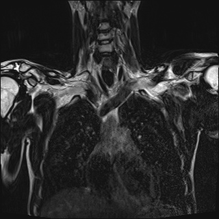 File:Bilateral spinoglenoid notch ganglion cysts (Radiopaedia 29577-30082 Coronal T2 42).jpg