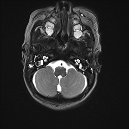 File:Bilateral subdural hemorrhage and parietal skull fracture (Radiopaedia 26058-26190 Axial T2 7).png