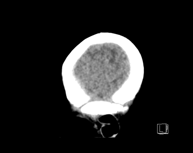 File:Bilateral subdural hemorrhage and parietal skull fracture (Radiopaedia 26058-26192 C 22).png