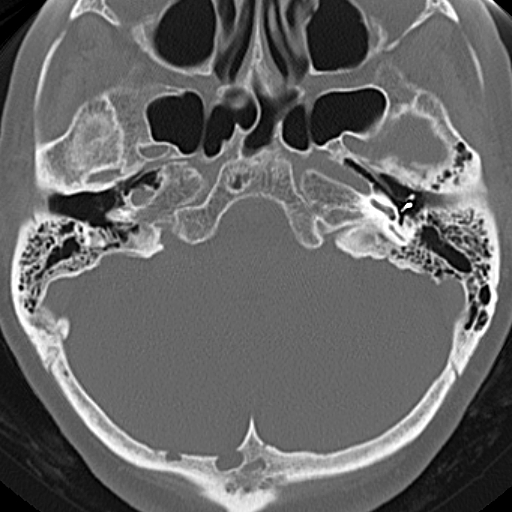 File:Bilateral tympanoplasty (Radiopaedia 16947-16664 Axial bone window 16).jpg