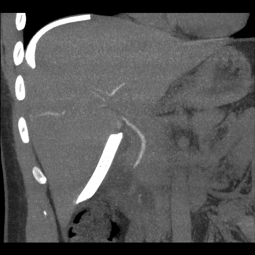 File:Bile leak from liver traumatic laceration (Radiopaedia 63463-72077 Coronal Biliscopin 15).jpg