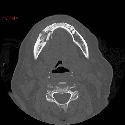 Bisphosphonate-related osteonecrosis of the jaw (Radiopaedia 54147-60329 Axial bone window 38).jpg