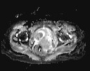 File:Bladder rhabdomyosarcoma (Radiopaedia 27231-27407 Axial ADC 2).jpg