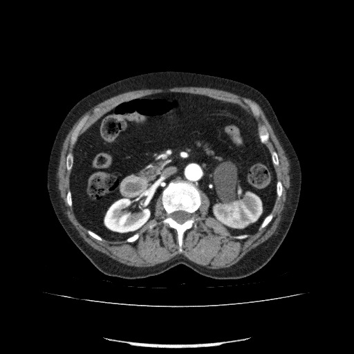 File:Bladder tumor detected on trauma CT (Radiopaedia 51809-57609 A 104).jpg