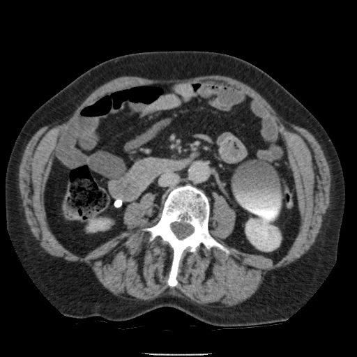 Bladder tumor detected on trauma CT (Radiopaedia 51809-57609 C 70).jpg