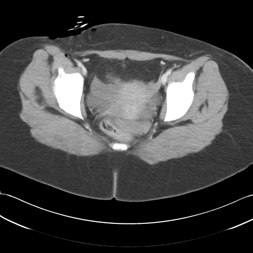 File:Blood in uterovesical and rectovesical pouch in trauma patient (Radiopaedia 34090-35340 C 49).png