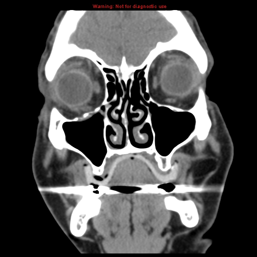 File:Blowout fracture with inferior rectus entrapment (Radiopaedia 12418-12673 Coronal non-contrast 7).jpg
