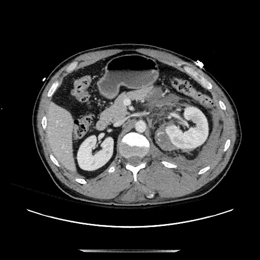 Blunt abdominal trauma with solid organ and musculoskelatal injury with active extravasation (Radiopaedia 68364-77895 A 51).jpg