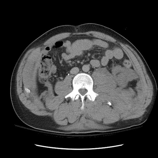 Blunt abdominal trauma with solid organ and musculoskelatal injury with active extravasation (Radiopaedia 68364-77895 Axial C+ delayed 76).jpg