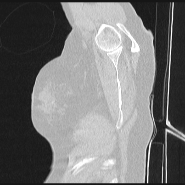 Boerhaave syndrome (Radiopaedia 45644-49799 Sagittal lung window 86).jpg