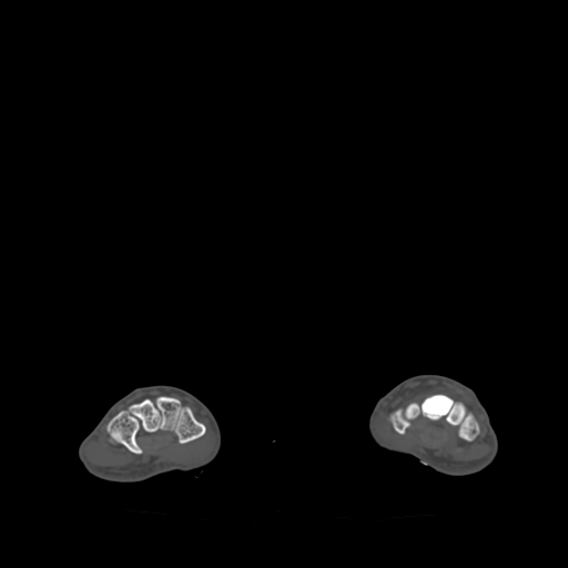 File:Bone islands - carpus (Radiopaedia 63141-71658 Axial bone window 37).jpg