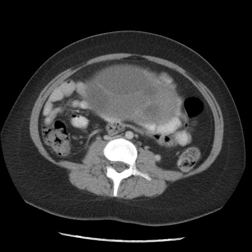 File:Borderline mucinous tumor (ovary) (Radiopaedia 78228-90808 A 95).jpg