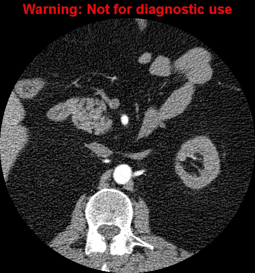 File:Bosniak renal cyst - type IV (Radiopaedia 23402-23466 B 17).jpg
