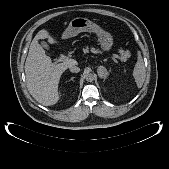Bosniak renal cyst - type IV (Radiopaedia 24244-24518 Axial non-contrast 125).jpg