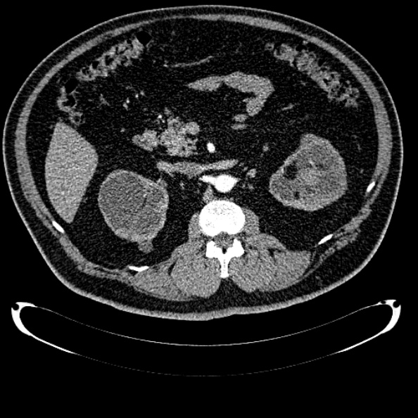 Bosniak renal cyst - type IV (Radiopaedia 24244-24518 B 130).jpg