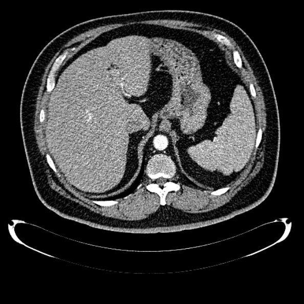Bosniak renal cyst - type IV (Radiopaedia 24244-24518 B 62).jpg