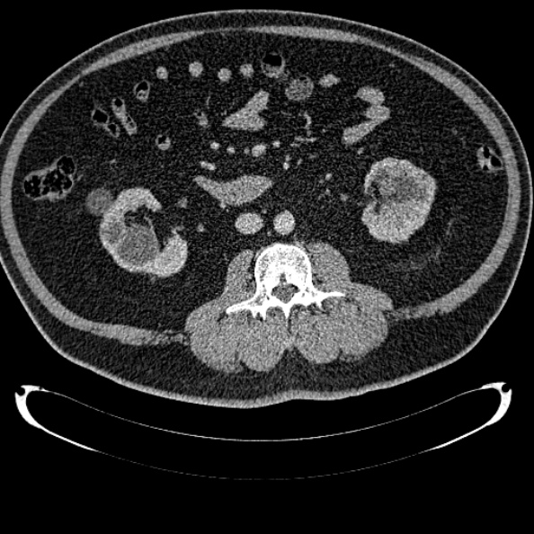 File:Bosniak renal cyst - type IV (Radiopaedia 24244-24518 C 189).jpg