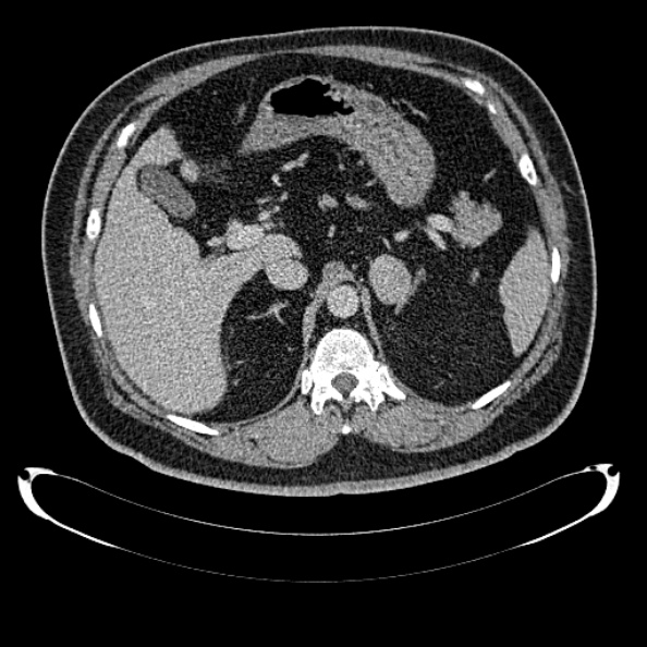 Bosniak renal cyst - type IV (Radiopaedia 24244-24518 C 83).jpg