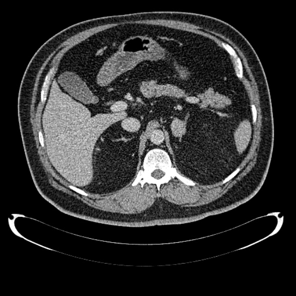 Bosniak renal cyst - type IV (Radiopaedia 24244-24518 C 91).jpg