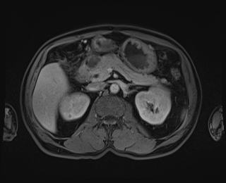 Bouveret syndrome (Radiopaedia 61017-68856 Axial T1 C+ fat sat 37).jpg
