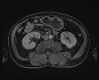 Bouveret syndrome (Radiopaedia 61017-68856 Axial T1 C+ fat sat 52).jpg