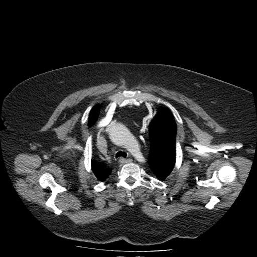 Bovine aortic arch - right internal mammary vein drains into the superior vena cava (Radiopaedia 63296-71875 A 26).jpg