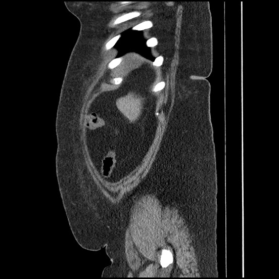 Bowel and splenic infarcts in acute lymphocytic leukemia (Radiopaedia 61055-68913 C 18).jpg